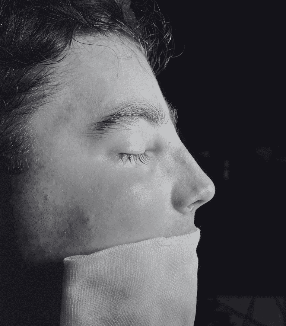 rinoplastia ultrasónica