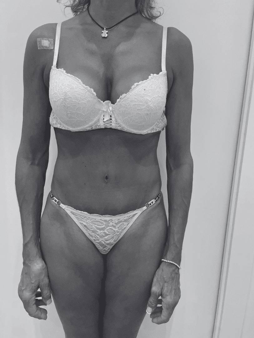 abdominoplastia_antesydespués