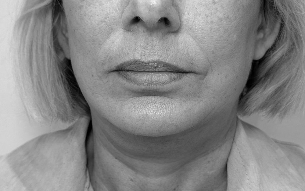 2como se hace lifting cervicofacial despues frente