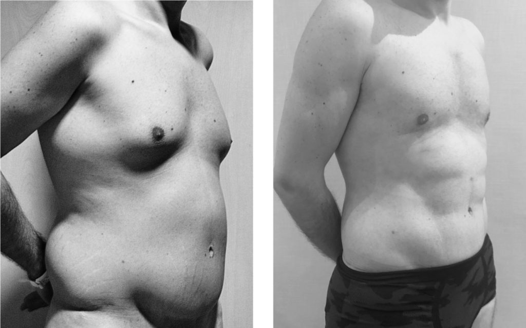 antes y después de la cirugía bariátrica y post bariátrica