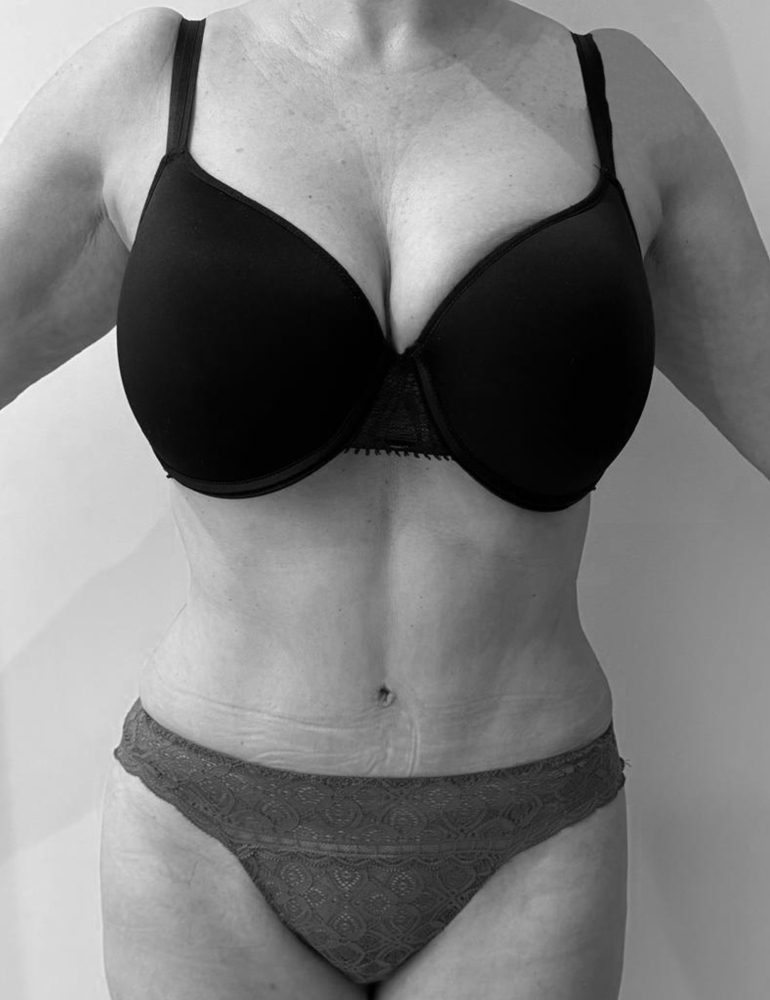 cirugia del abdomen despues frente