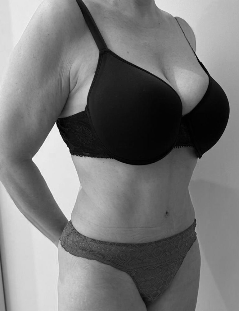 cirugia del abdomen despues lateral