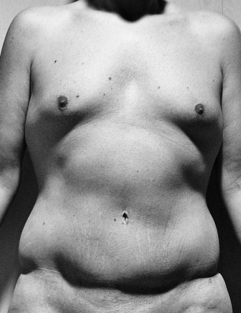 cirugia post bariatrica para hombres frente antes