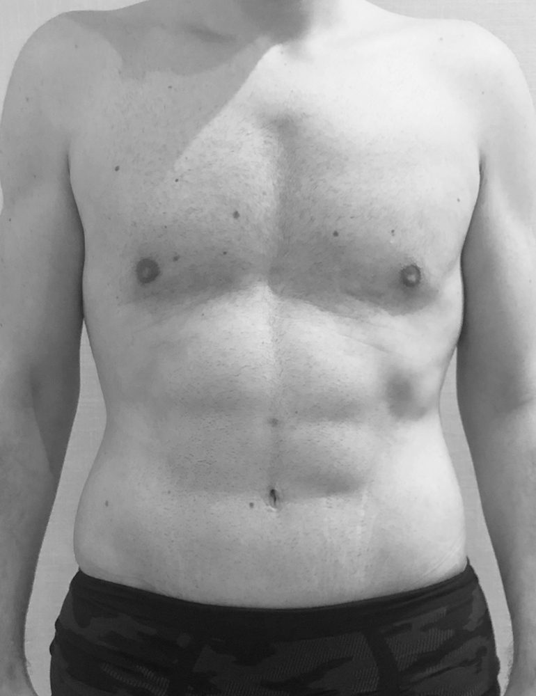 cirugia post bariatrica para hombres frente despues