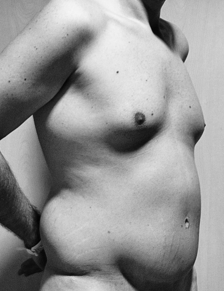 cirugia post bariatrica para hombres lateral antes