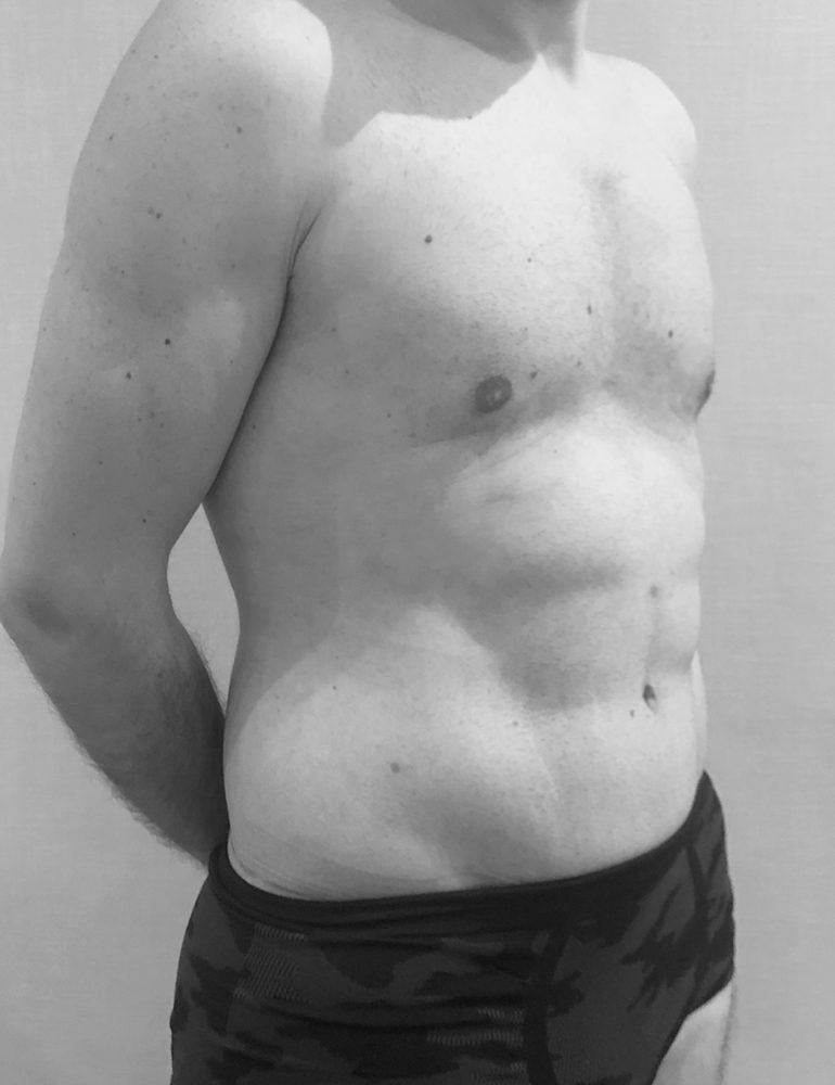 cirugia post bariatrica para hombres lateral despues