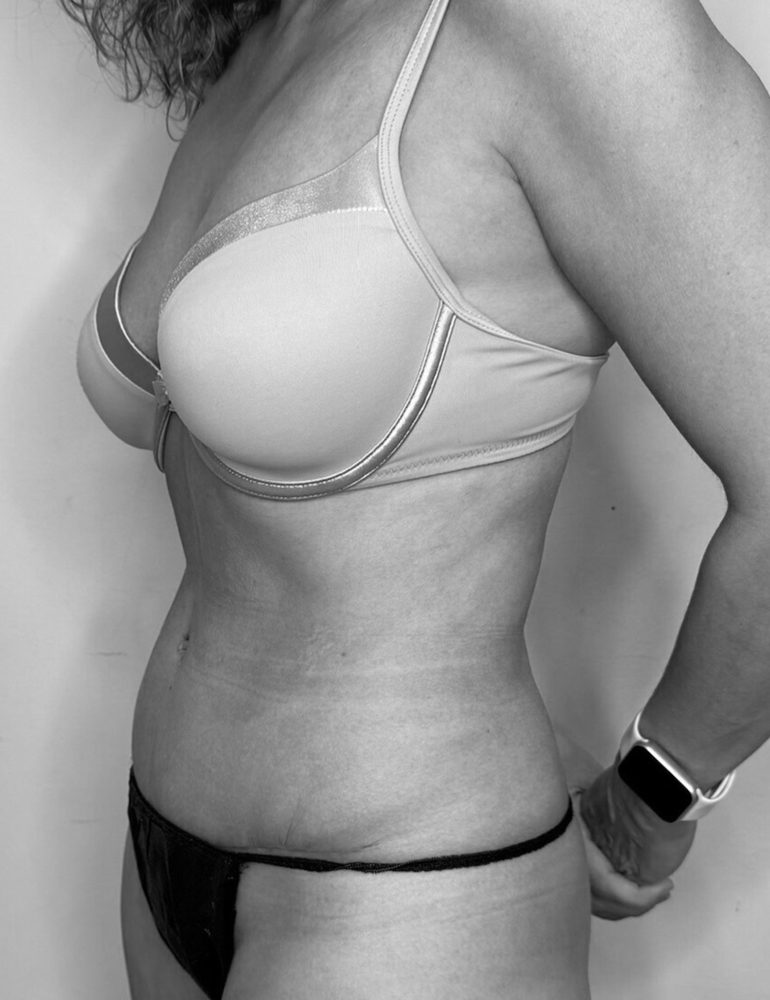 como se hace la abdominoplastia despues lateral