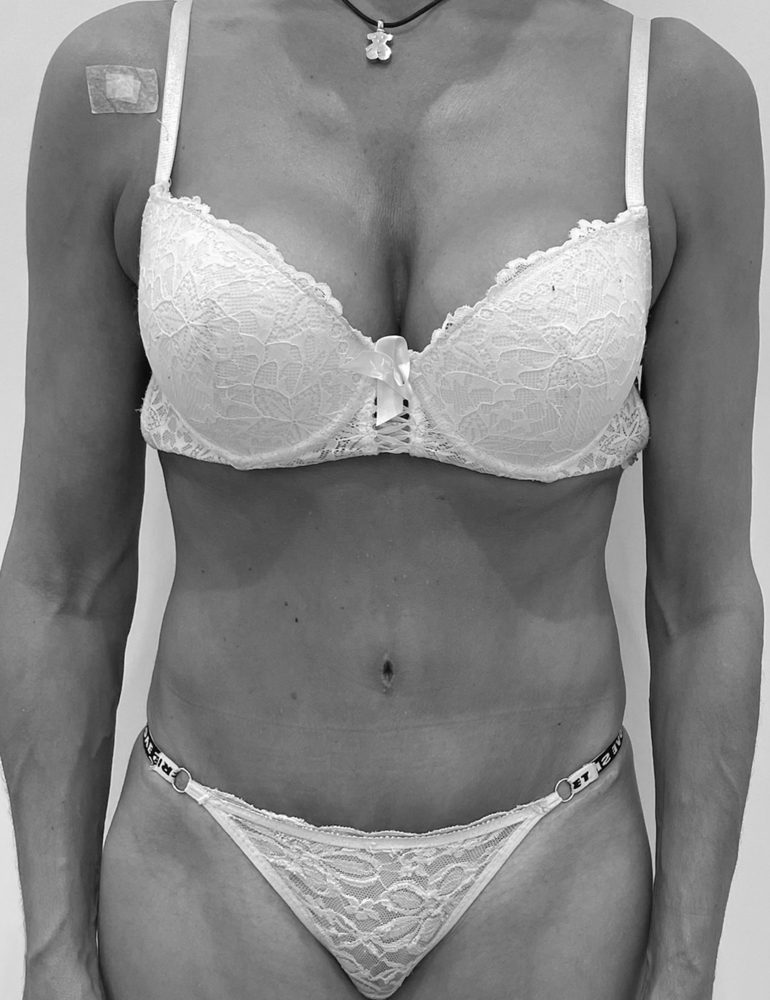 como se hace la cirugia abdominal despues frente