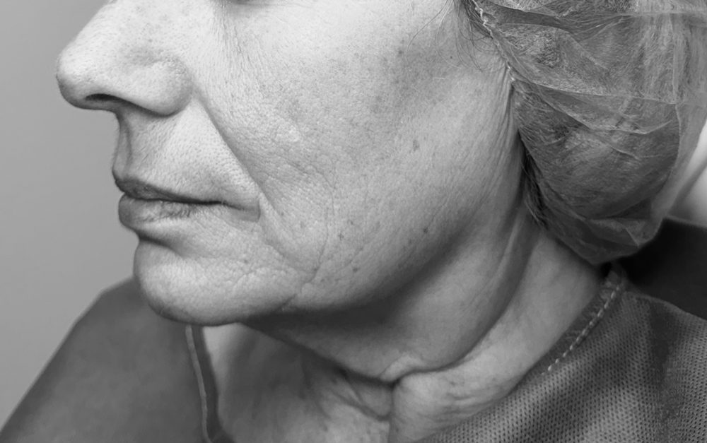 como se hace lifting cervicofacial antes lateral como se hace lifting cervicofacial antes lateral