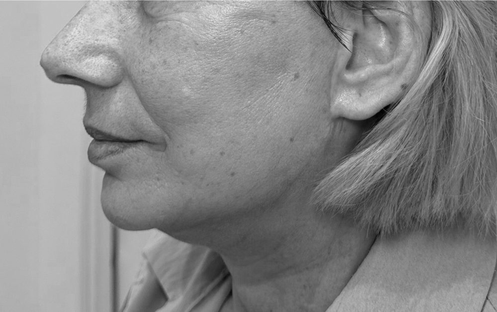 como se hace lifting cervicofacial despues lateral