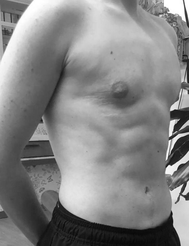 masculinizacion a traves de liposculpt 4d despues