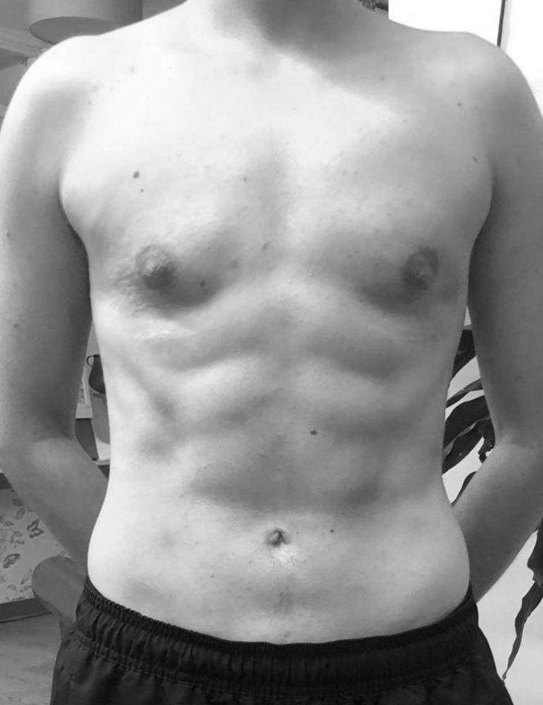 masculinizacion coporal liposculpt 4d despues