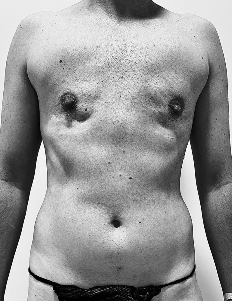 masculinizacion corporal liposculpt 4d antes