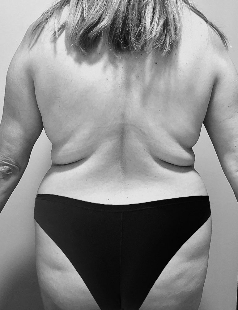 que es la abdominoplastia antes espalda