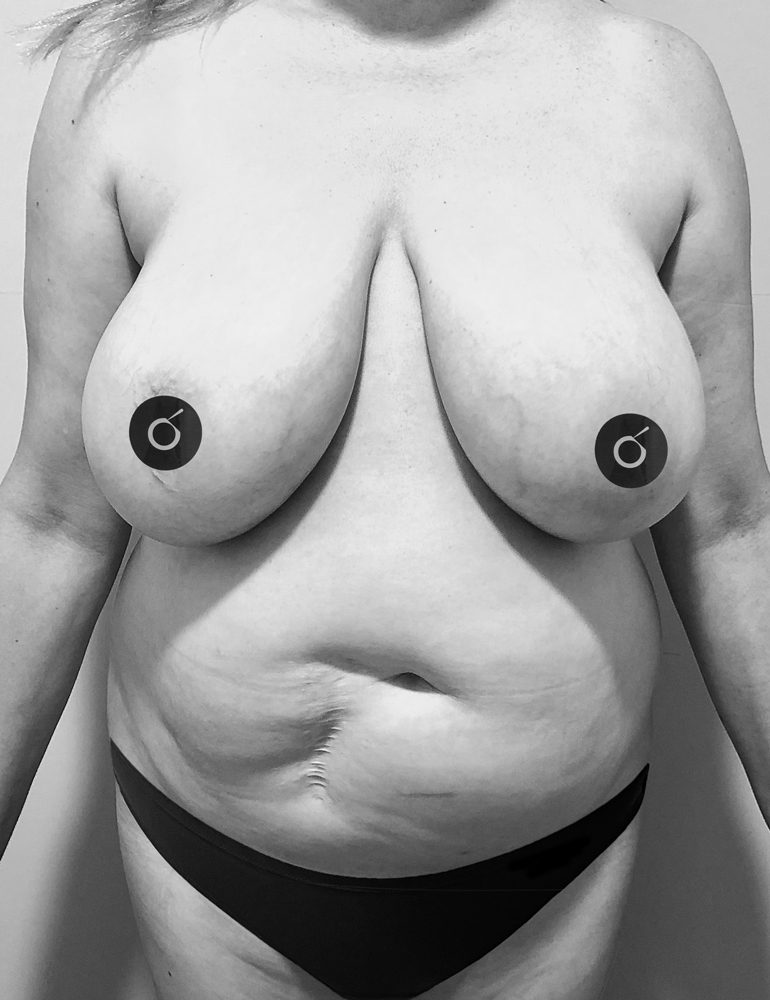 que es la abdominoplastia antes frente