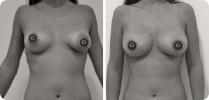 antes y después del aumento de pecho con lipofilling