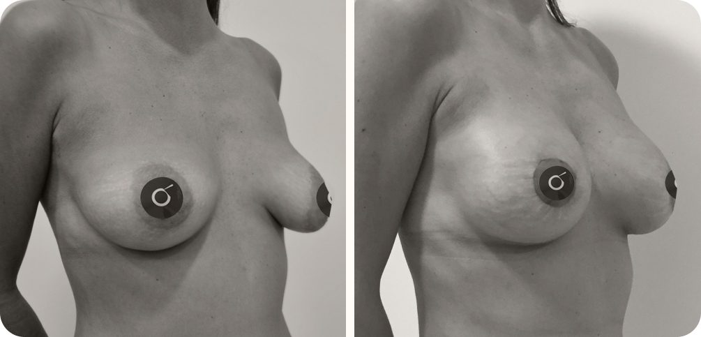 resultados del aumento de pecho con lipofilling