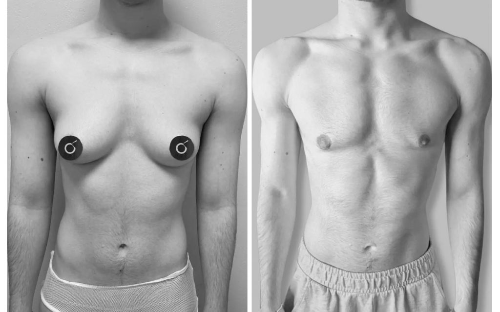 mastectomía para hombres trans