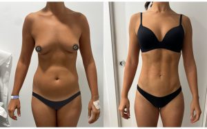 cómo se hace una lipoescultura con marcación abdominal