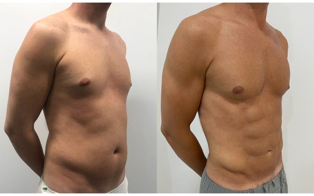 marcación abdominal en Barcelona