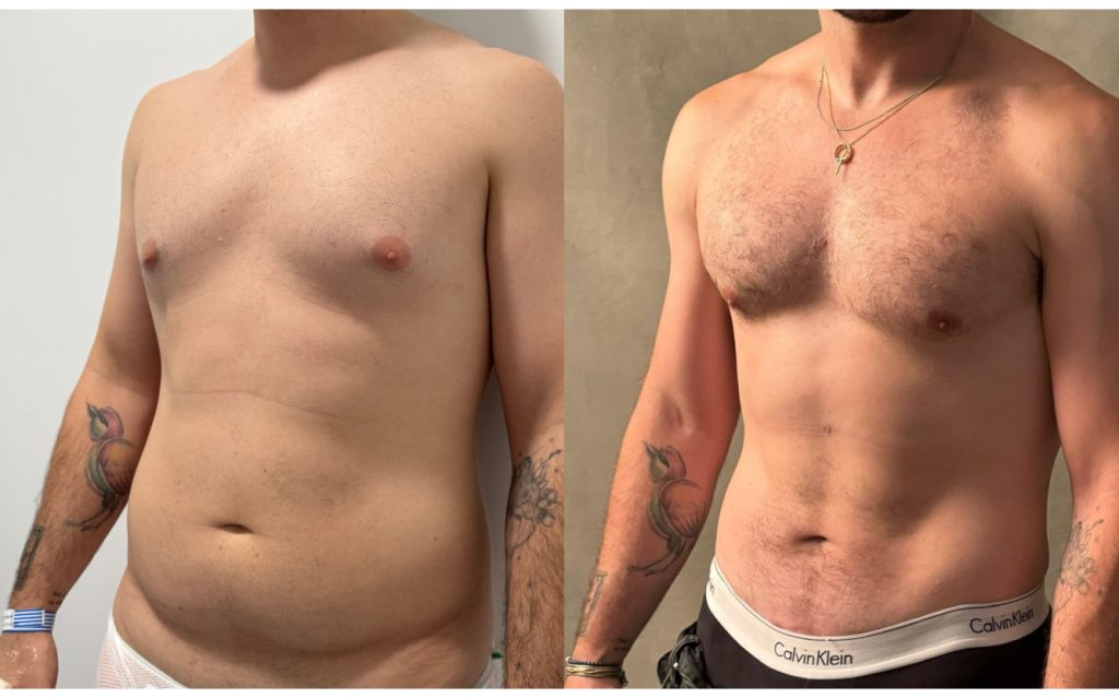 quién es el candidato ideal para una lipoescultura con marcación abdominal