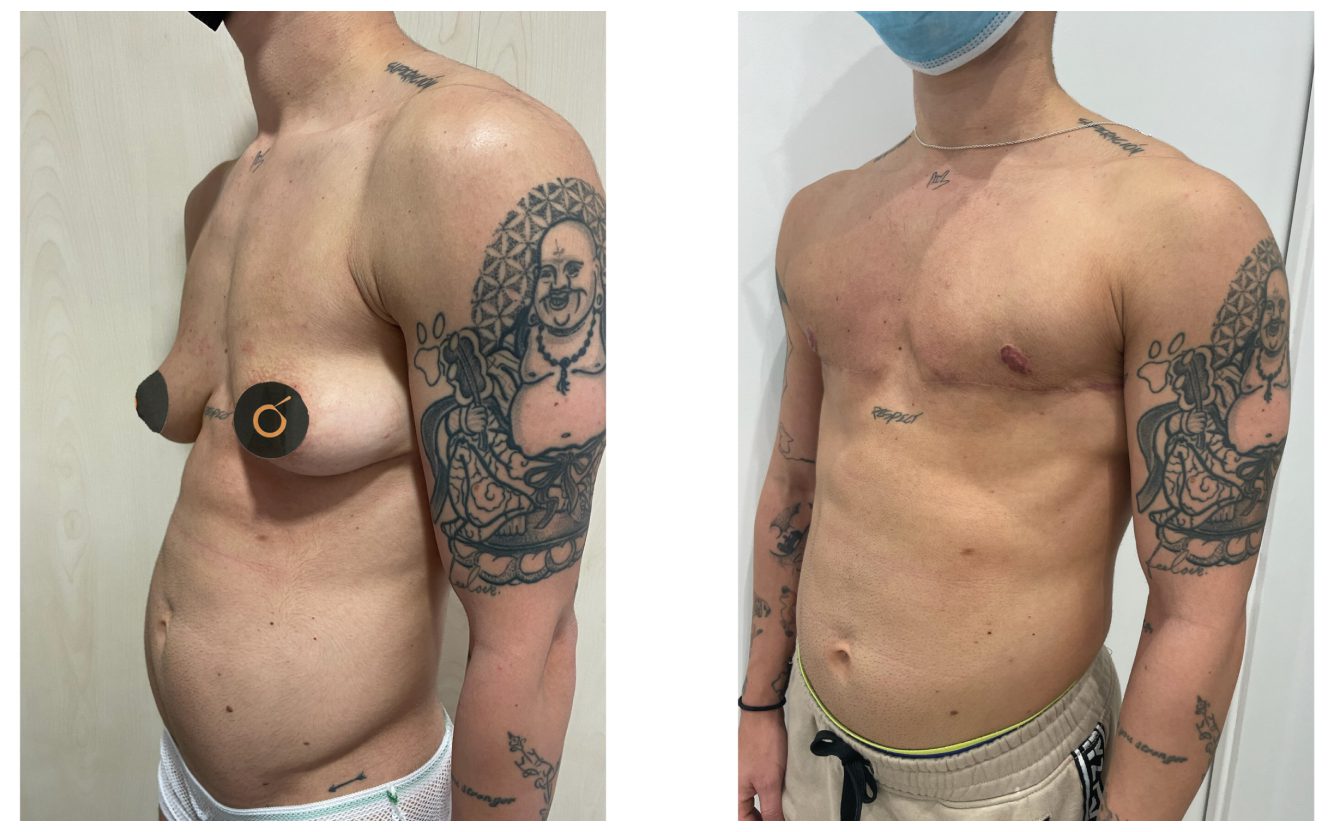 Mastectomía horizontal con injerto libre del pezón en hombre trans – contorno torácico definido por Clínica Brasó