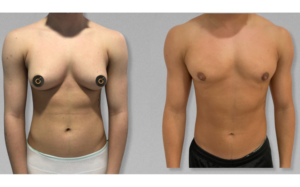 Antes y después de mastectomía subcutánea en hombre trans con resultado natural y cicatriz mínima – Clínica Brasó