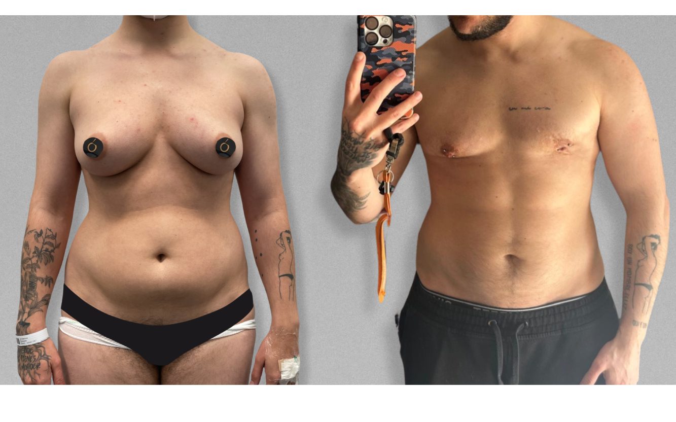 Resultado estético de mastectomía subcutánea con preservación del pezón en paciente trans – masculinización torácica en Clínica Brasó