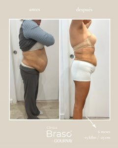 Antes y después en lipedema tratado con tirzepatida: reducción de volumen corporal