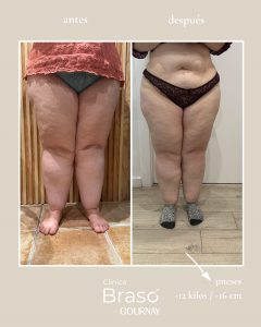 Antes y después en lipedema tratado con tirzepatida: reducción de volumen corporal