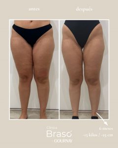 Antes y después en lipedema tratado con tirzepatida: reducción de volumen corporal