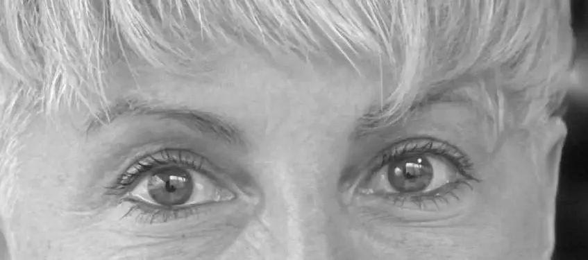 blefaroplastia-despues