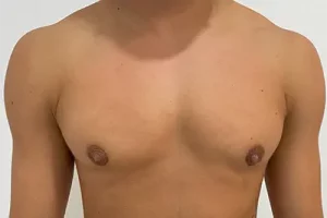 Mastectomia subcutanea ultrasonica Dra Braso