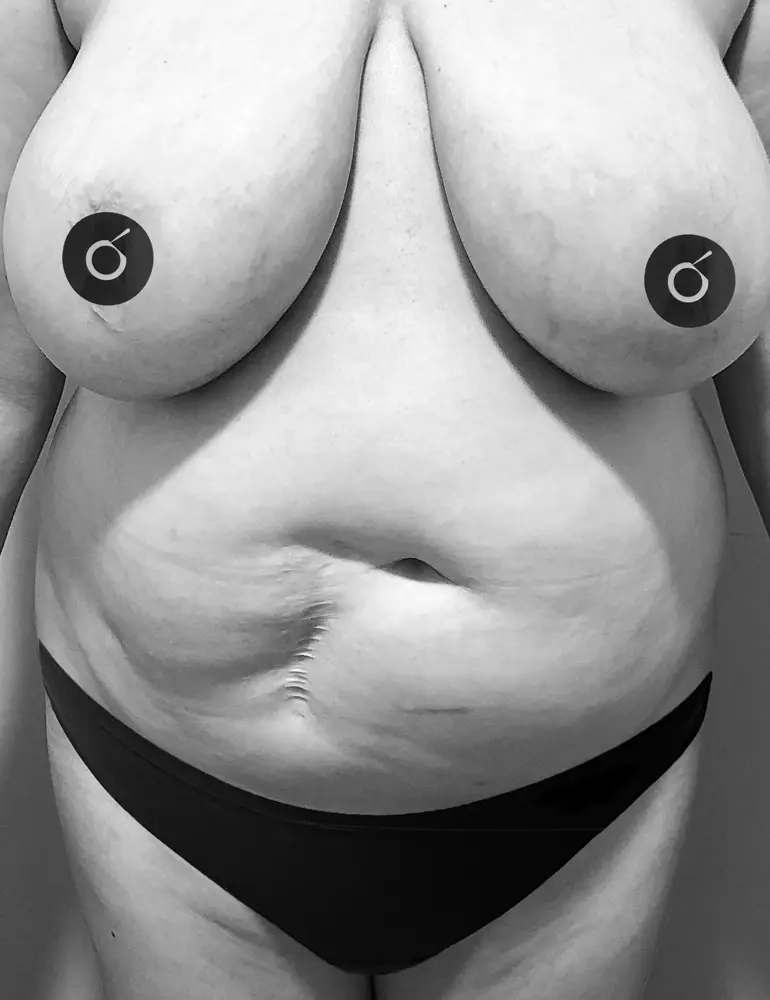 Abdominoplastia
