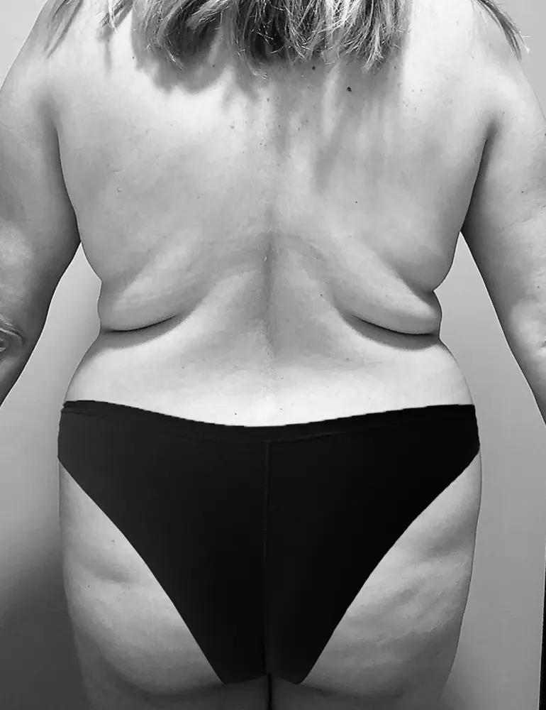 Abdominoplastia