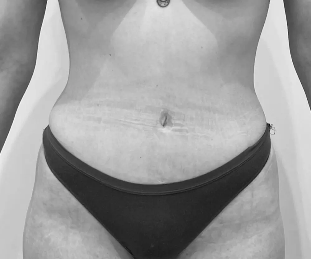 Abdominoplastia
