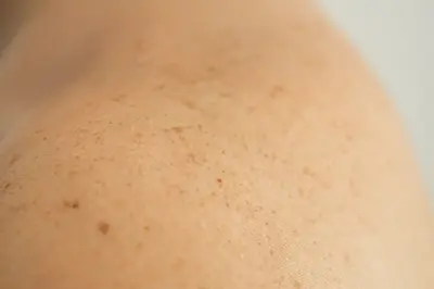 Eliminacion de manchas Dra Braso