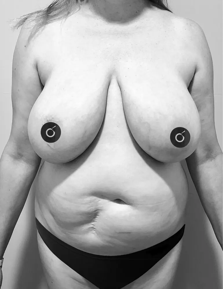 Mamoplastia de reducción