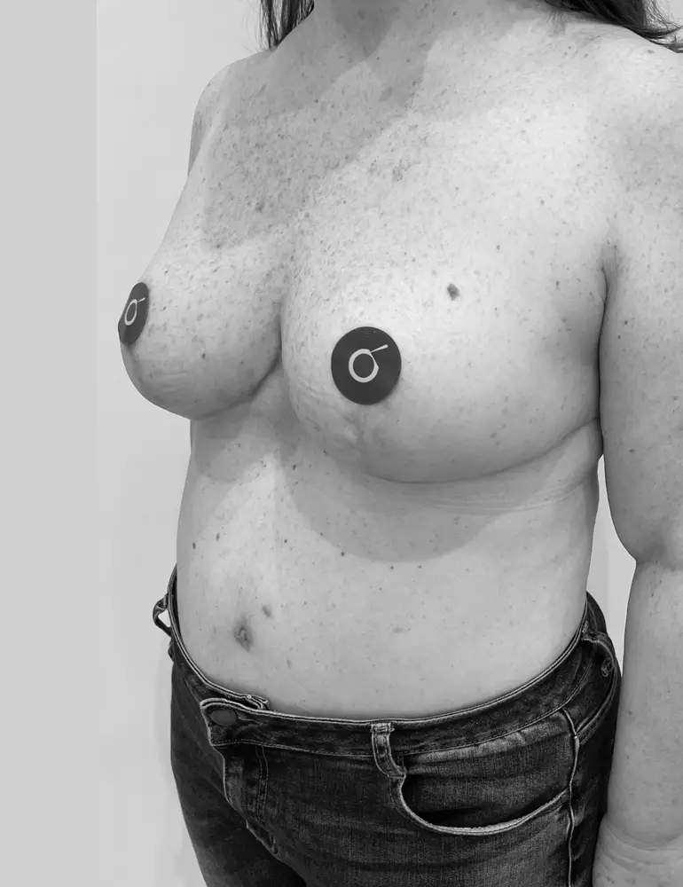 Mamoplastia de reducción