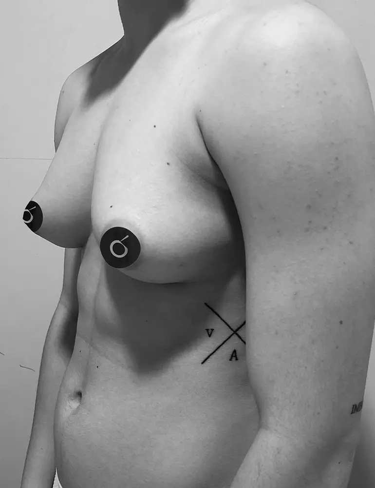 Mastectomía subcutanea ultrasónica