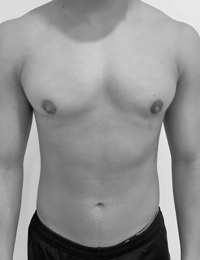 Mastectomía subcutanea ultrasónica