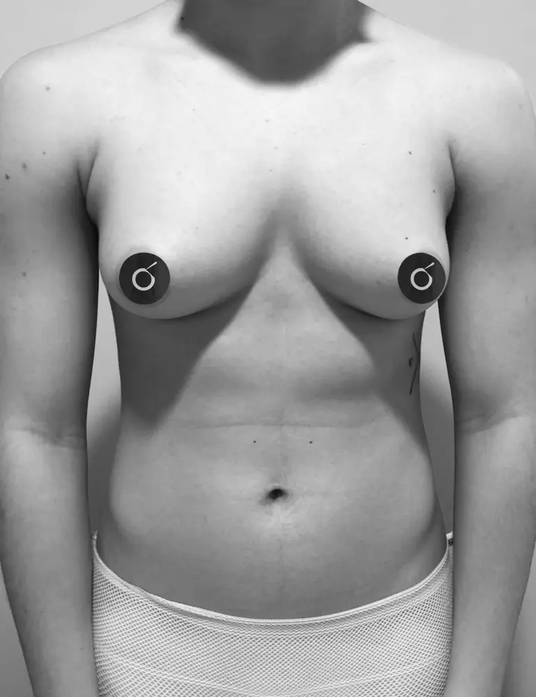 Mastectomía subcutanea ultrasónica