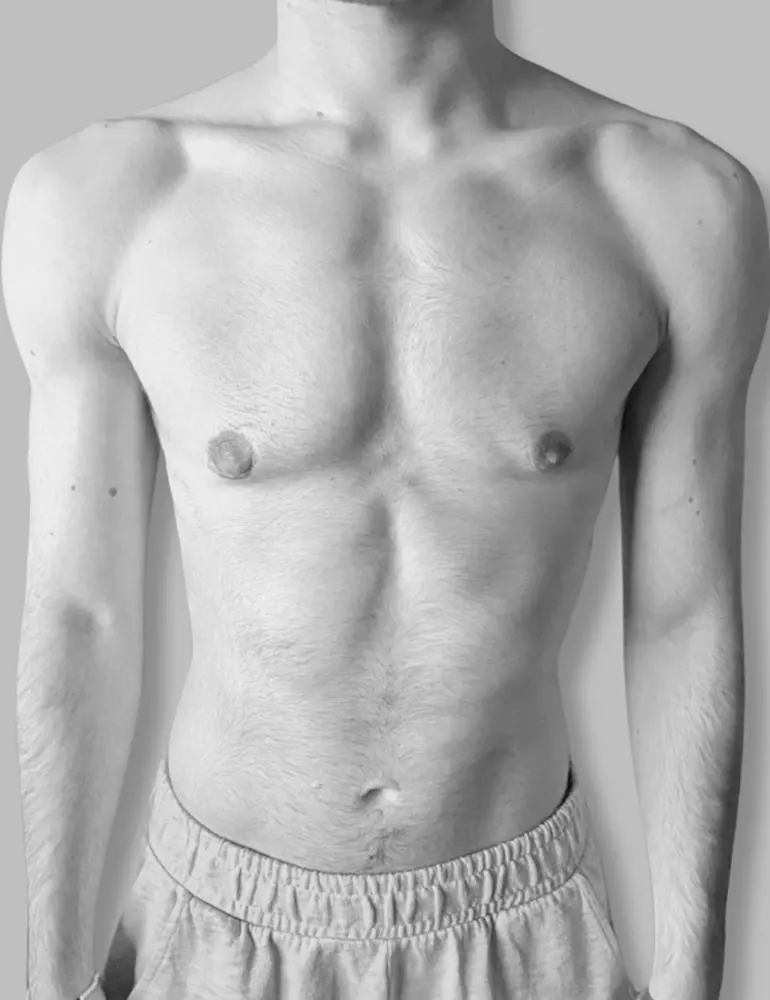 Mastectomía subcutanea ultrasónica