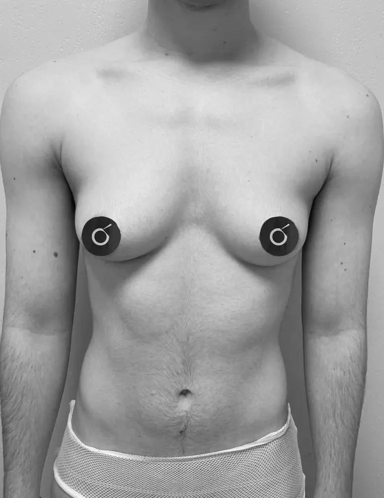 Mastectomía subcutanea ultrasónica