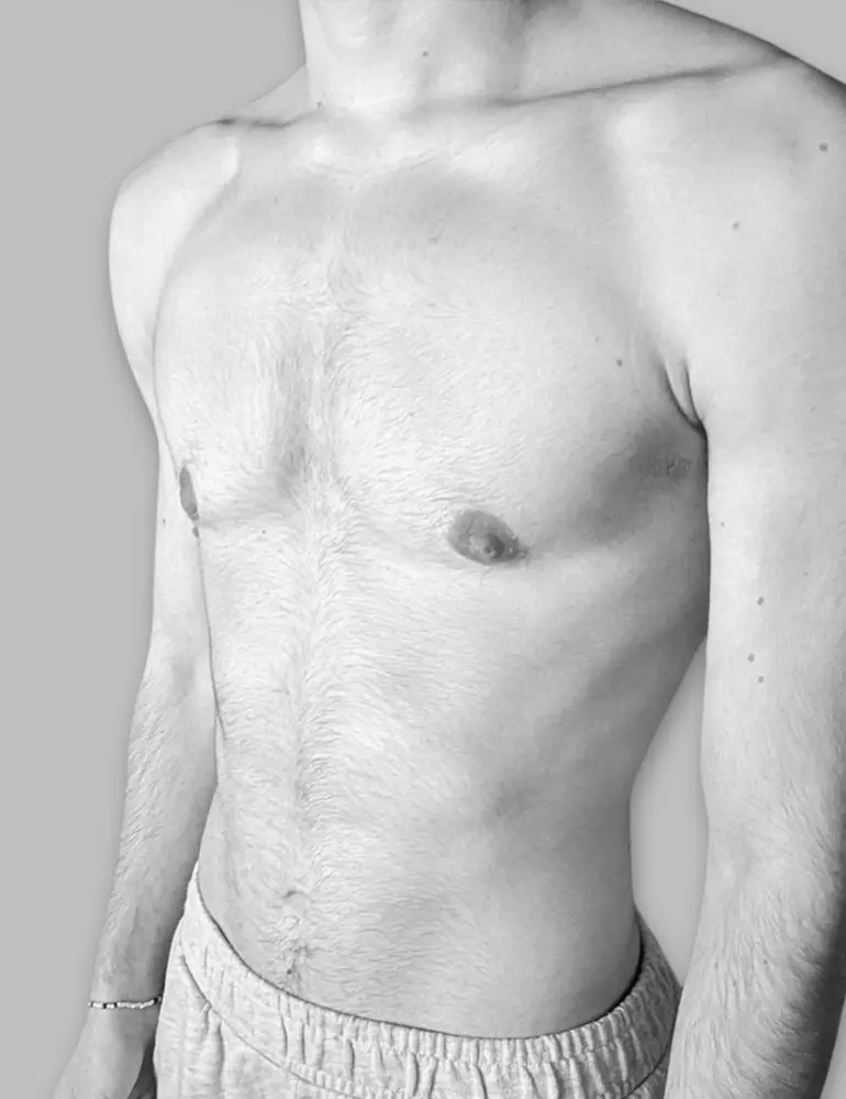 Mastectomía subcutanea ultrasónica