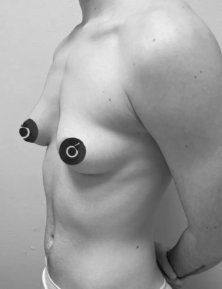 Mastectomía subcutanea ultrasónica