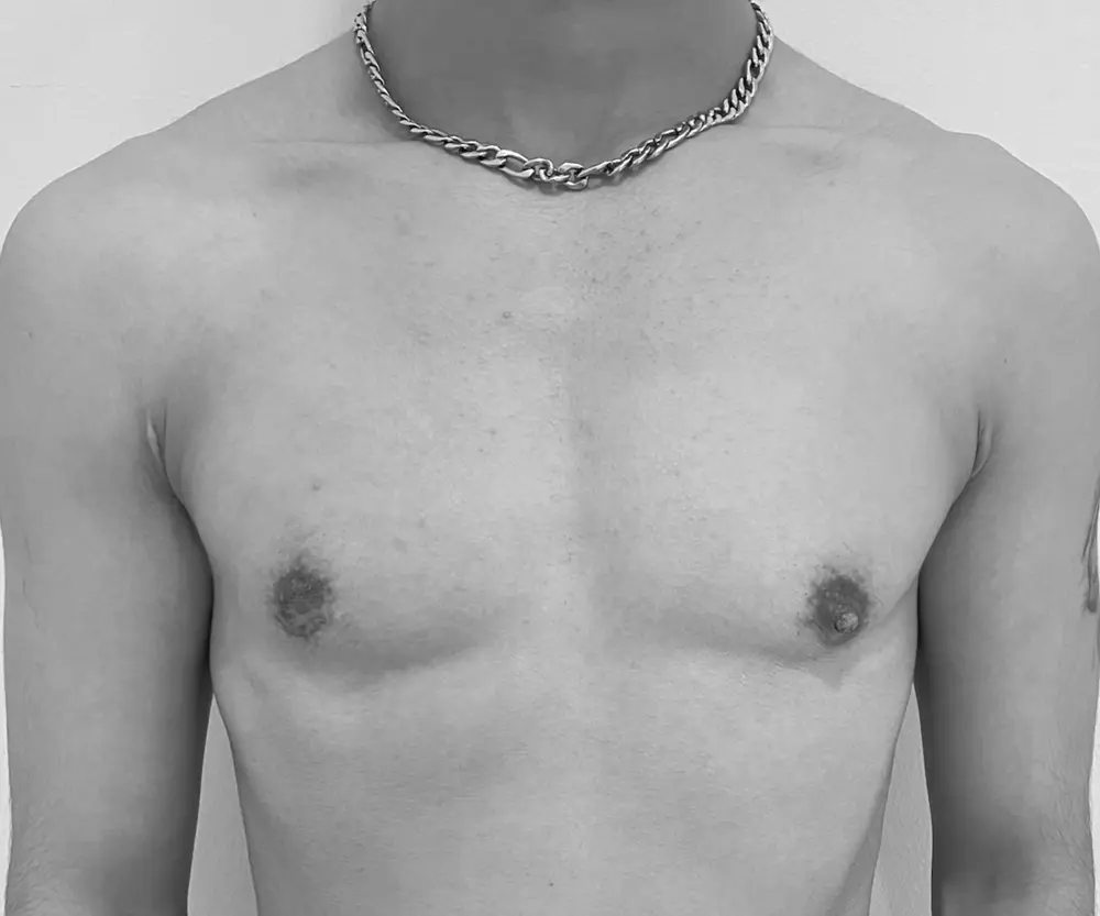 Mastectomía subcutanea ultrasónica