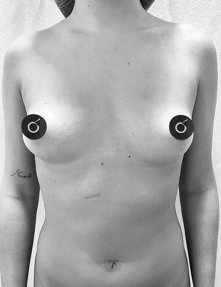 aumento con protesis a1