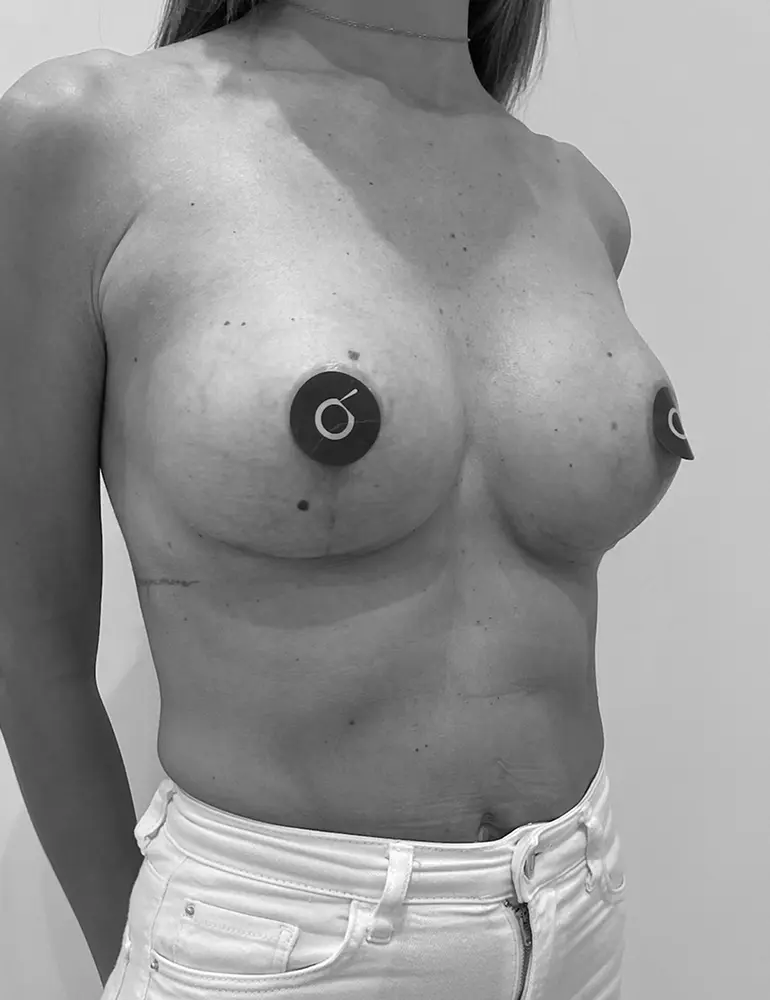 aumento con protesis c2