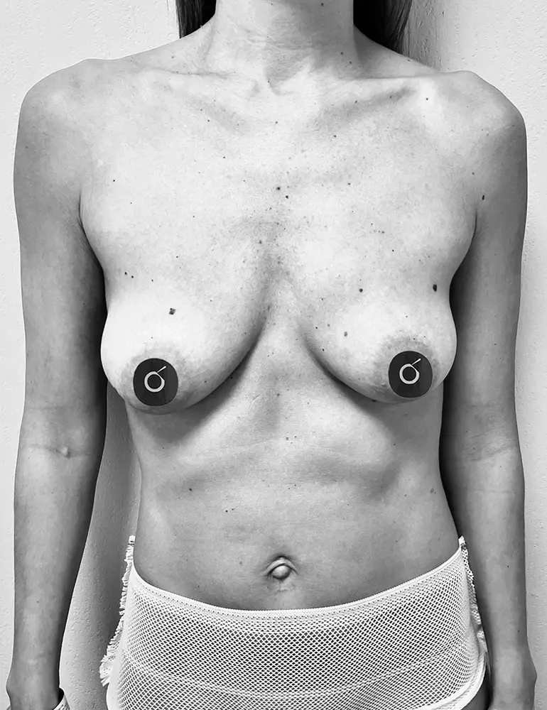 aumento con protesis d1